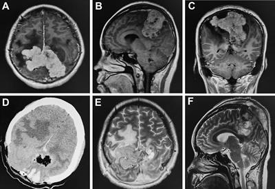 A pregnant woman with a giant bilateral parietal hemangiopericytoma underwent multiple surgeries and radiotherapy: a case report and literature review